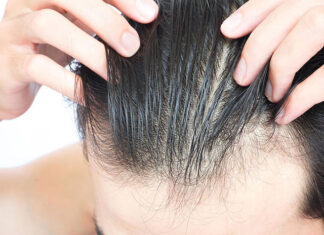 Jak wygląda transplantacja włosów i co należy o niej wiedzieć